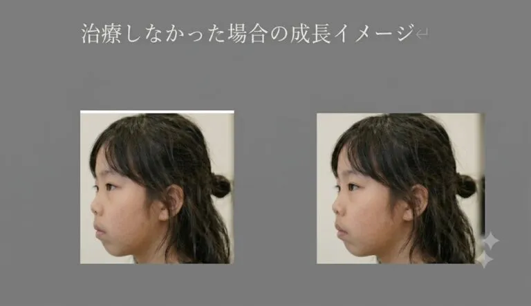 治療しなかった場合の成長イメージ