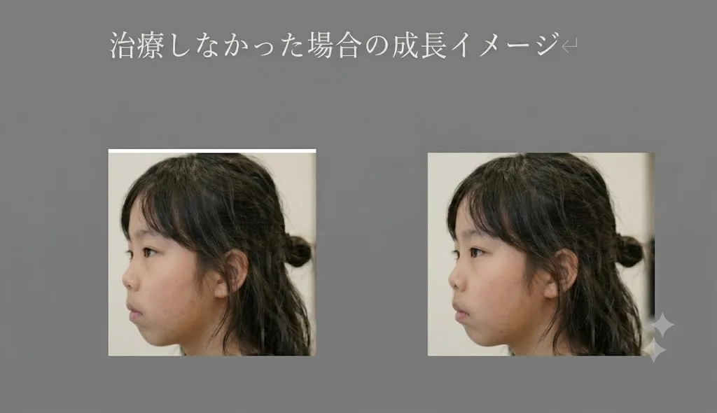 治療しなかった場合の成長イメージ