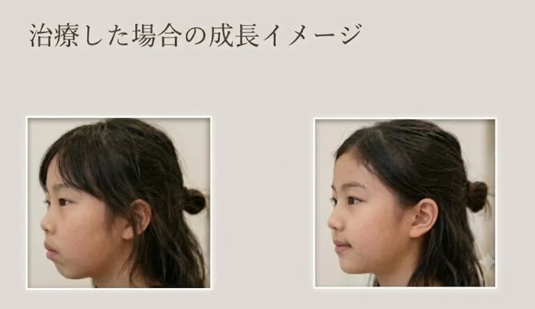 治療した場合の成長イメージ